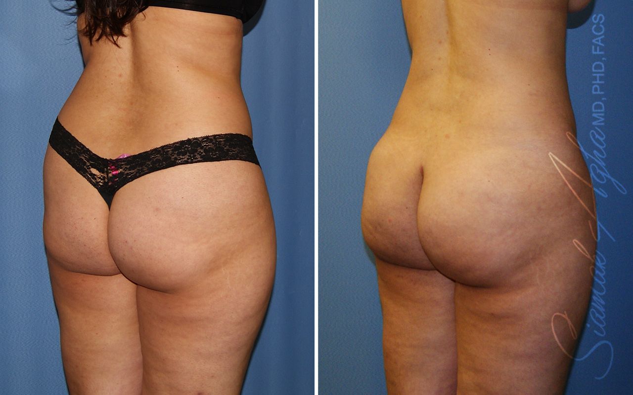 Liposuction Before & After