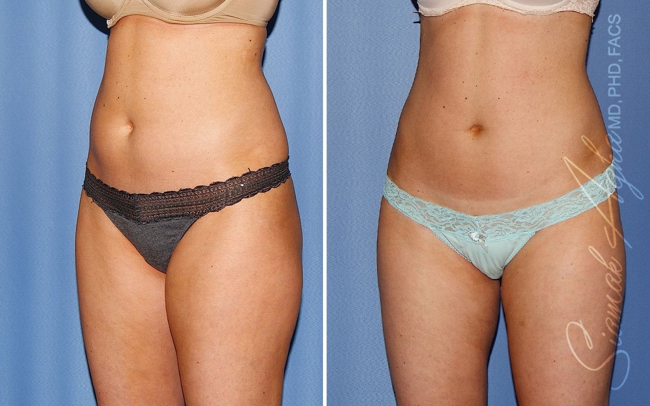 Liposuction Before & After