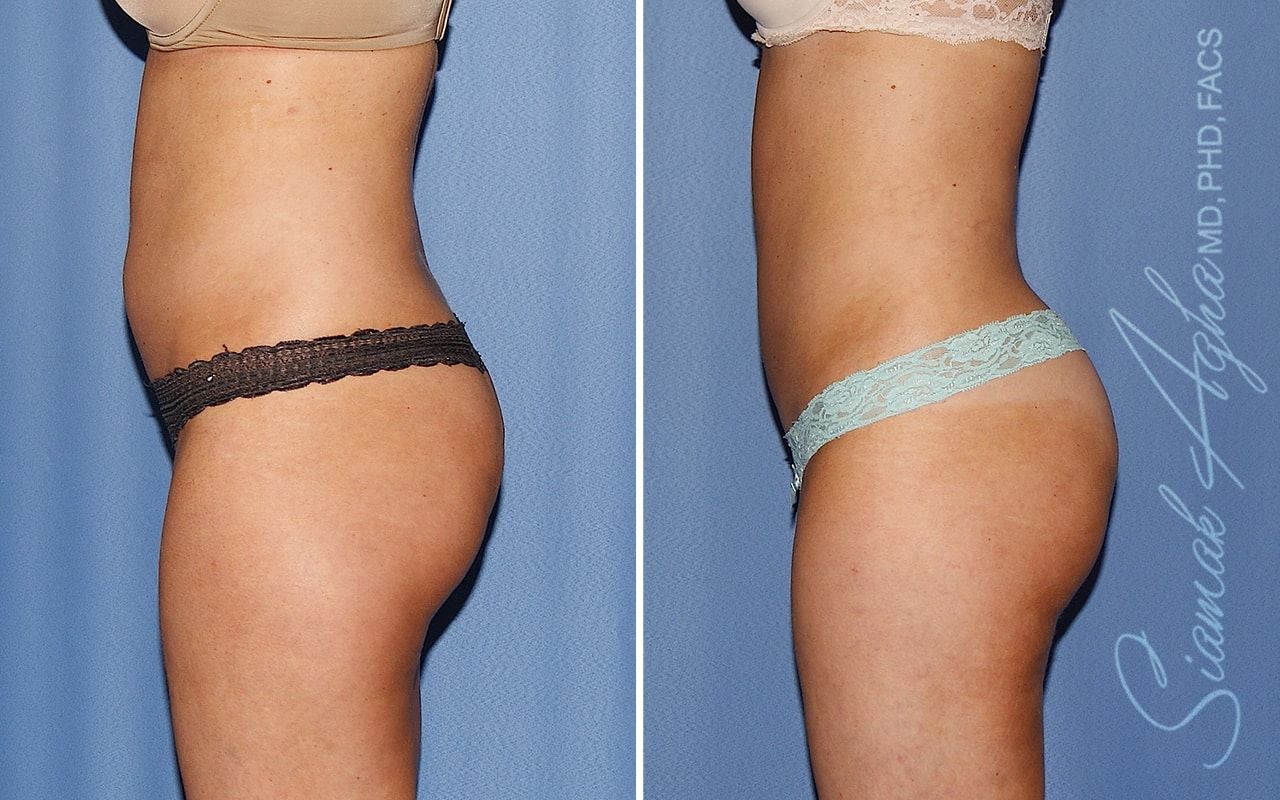 Liposuction Before & After