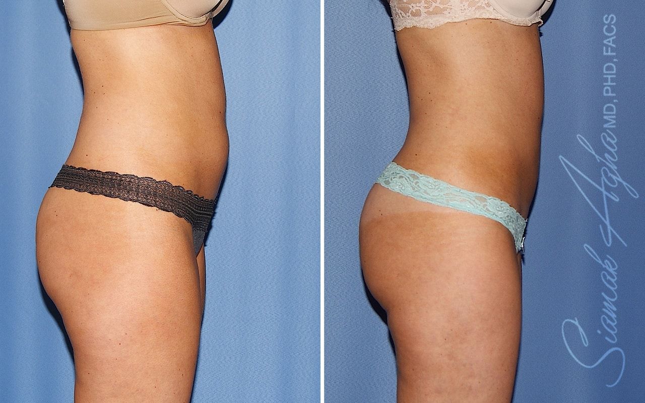 Liposuction Before & After