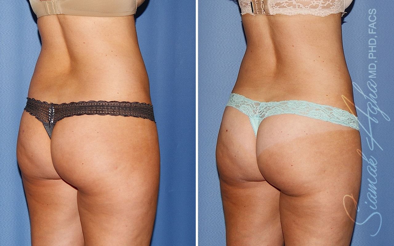 Liposuction Before & After