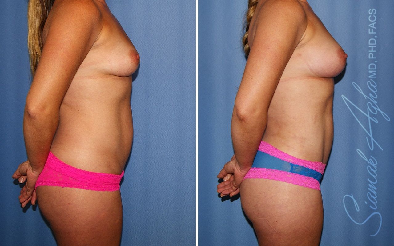 Liposuction Before & After