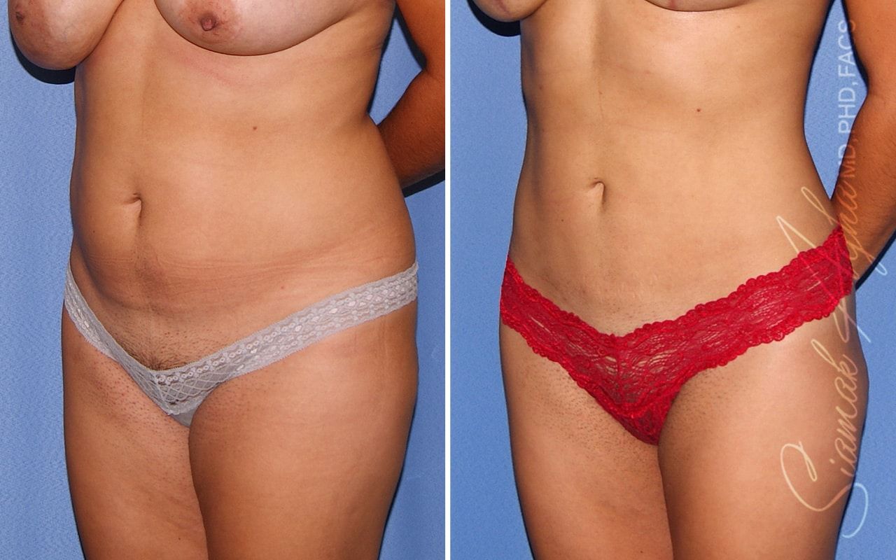 Liposuction Before & After