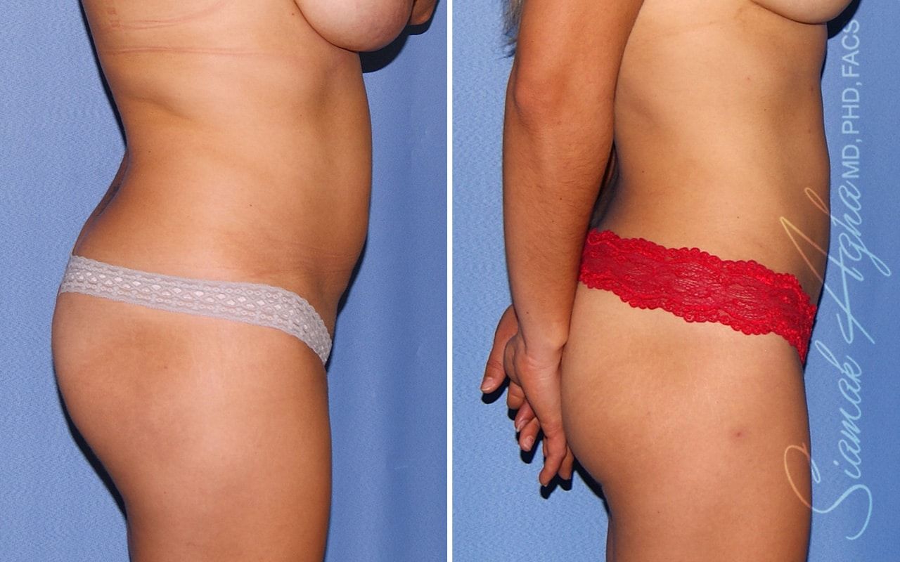 Liposuction Before & After