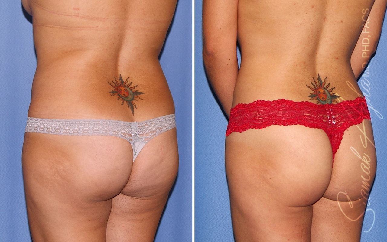 Liposuction Before & After