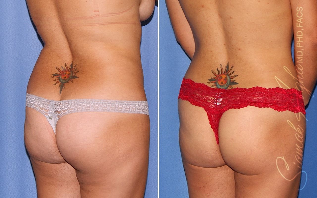 Liposuction Before & After