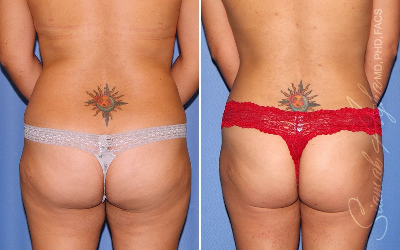 Liposuction Before & After