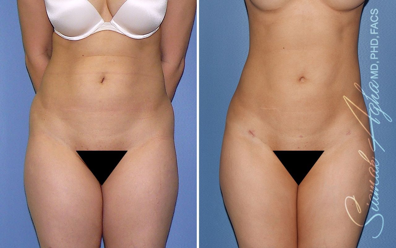 Liposuction Before & After