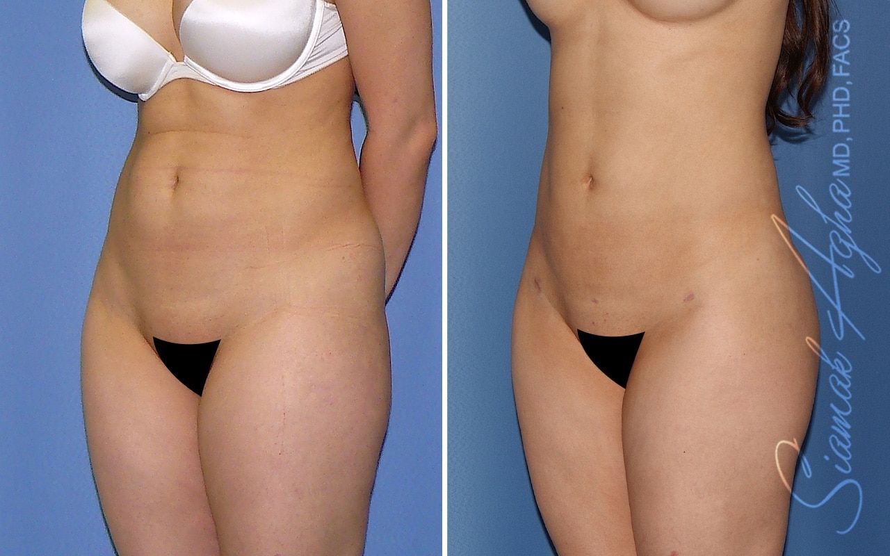 Liposuction Before & After