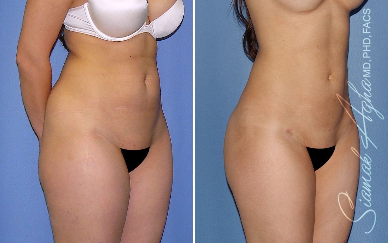 Liposuction Before & After