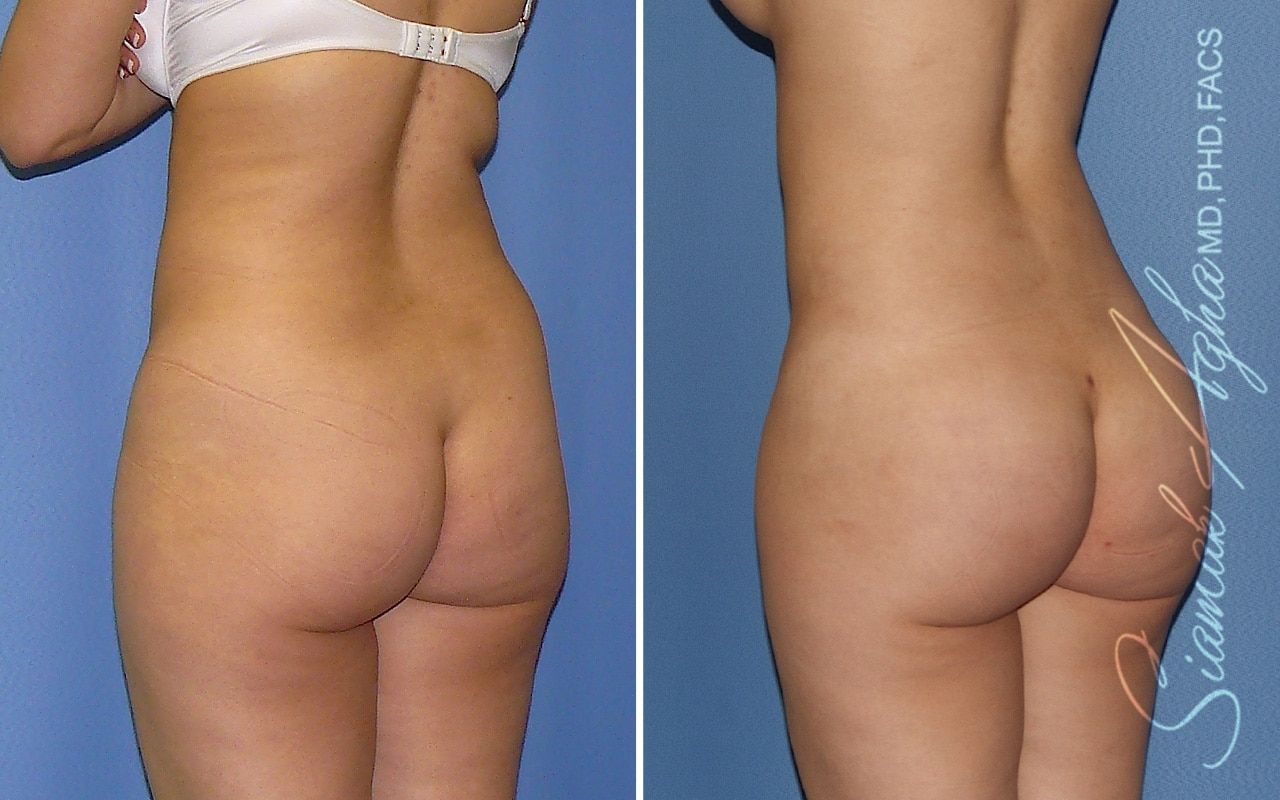 Liposuction Before & After