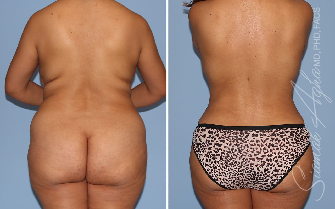 Liposuction Before & After