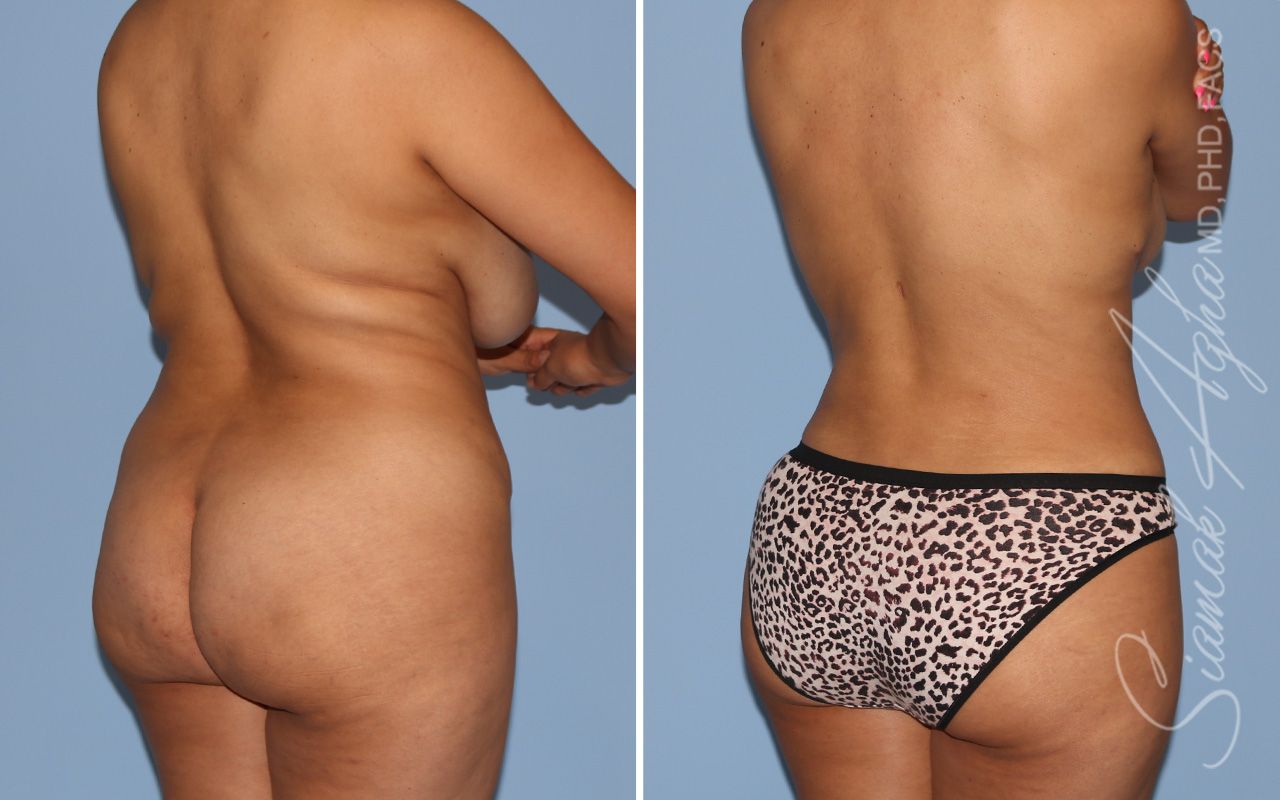 Liposuction Before & After