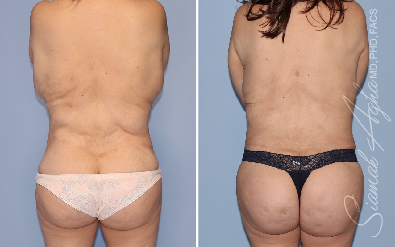 Liposuction Before & After