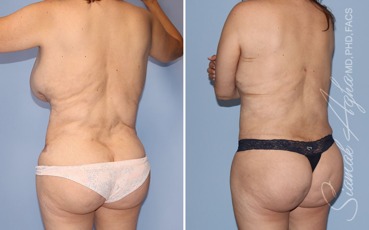 Liposuction Before & After