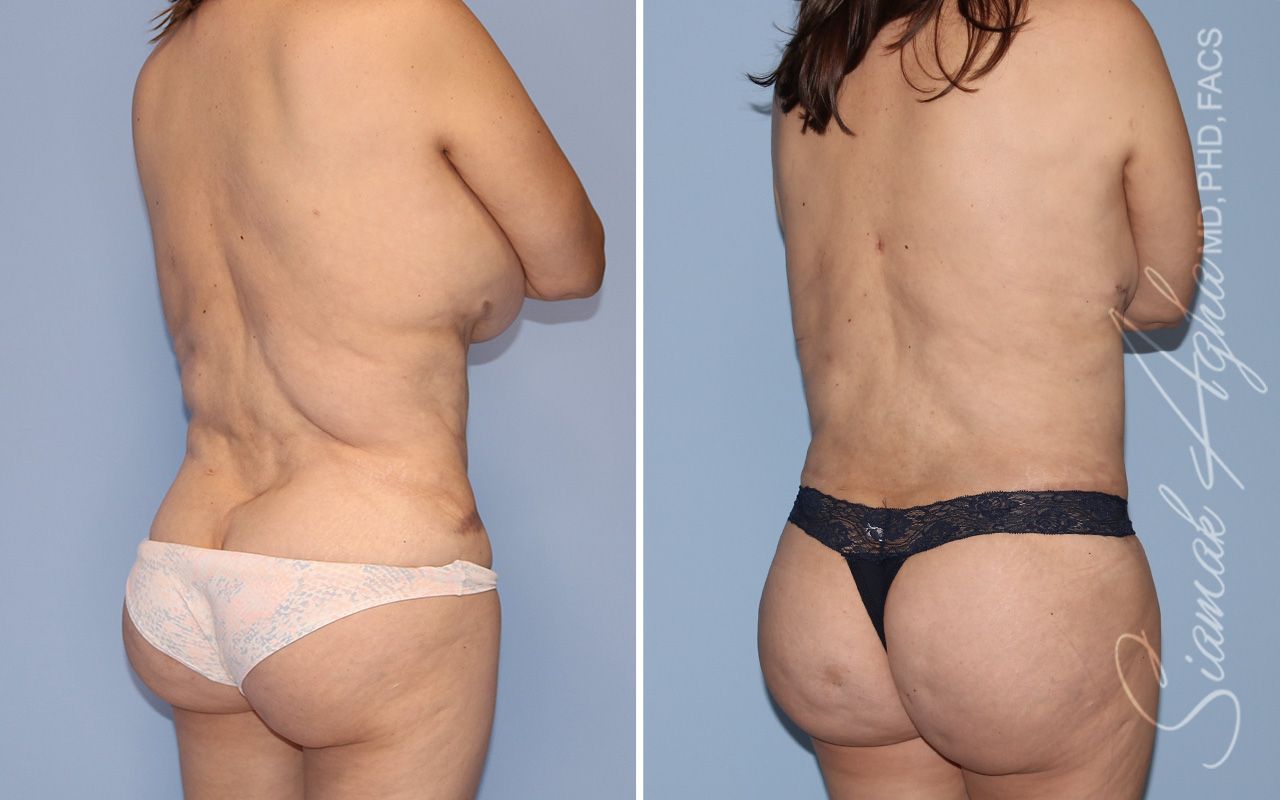 Liposuction Before & After