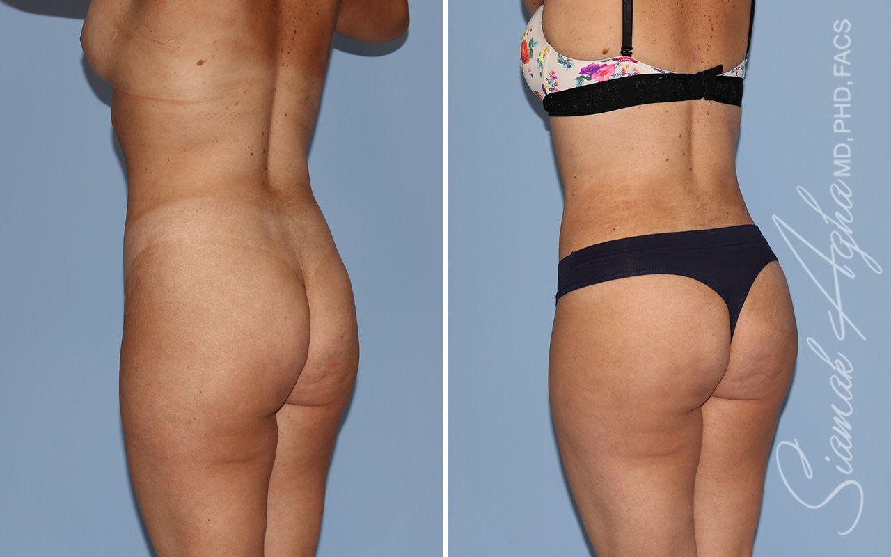 Liposuction Before & After