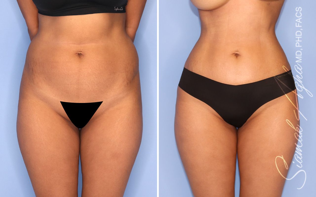 Liposuction Before & After