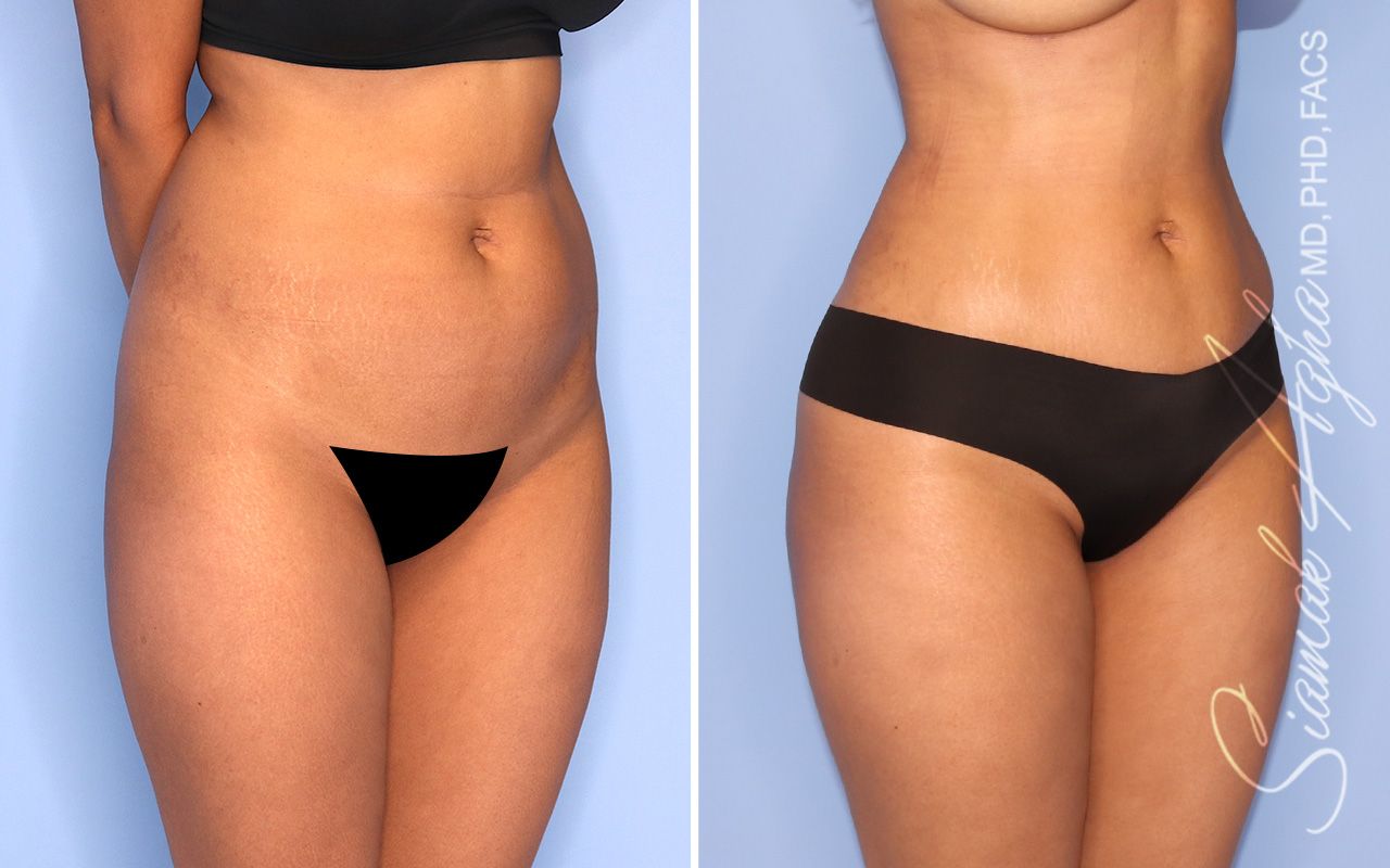 Liposuction Before & After