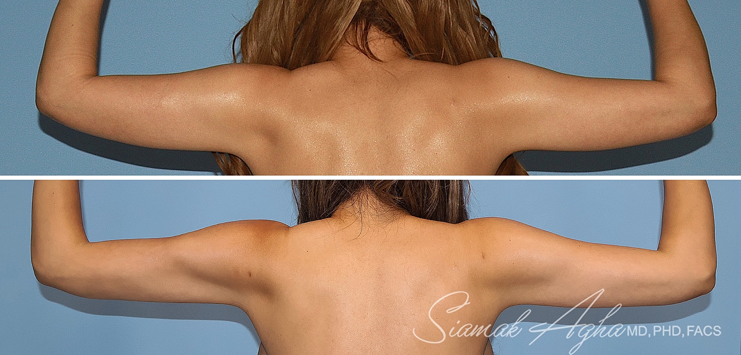 Liposuction Before & After