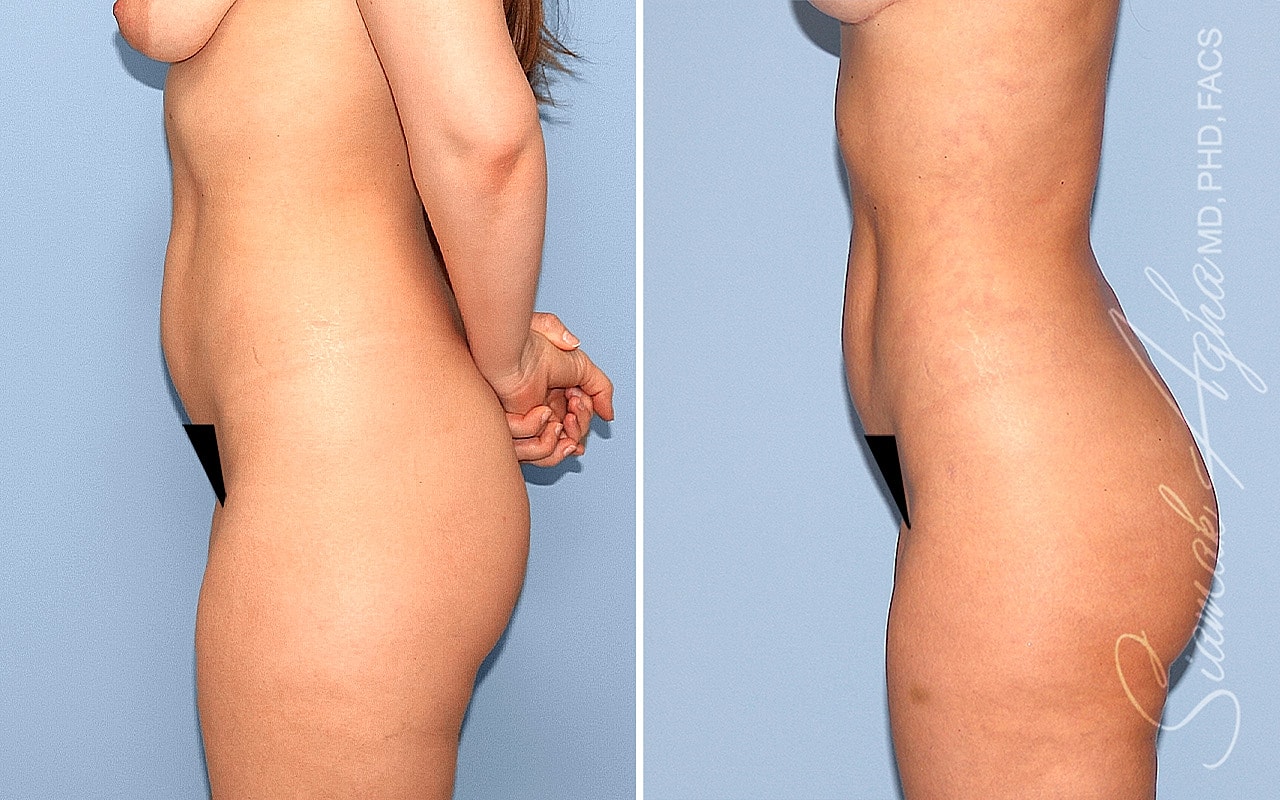 Liposuction Before & After