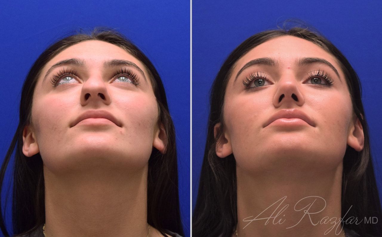 Rhinoplasty Before & After