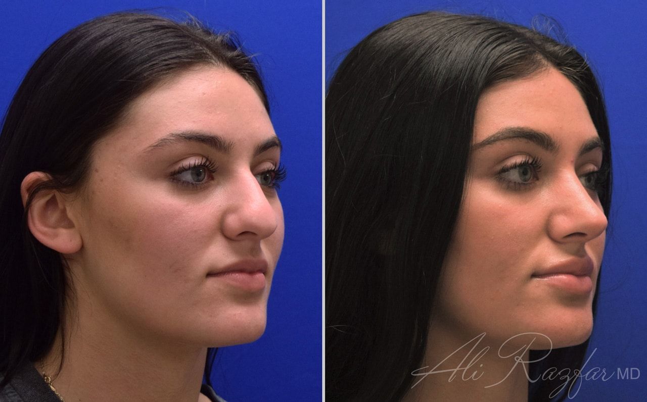 Rhinoplasty Before & After