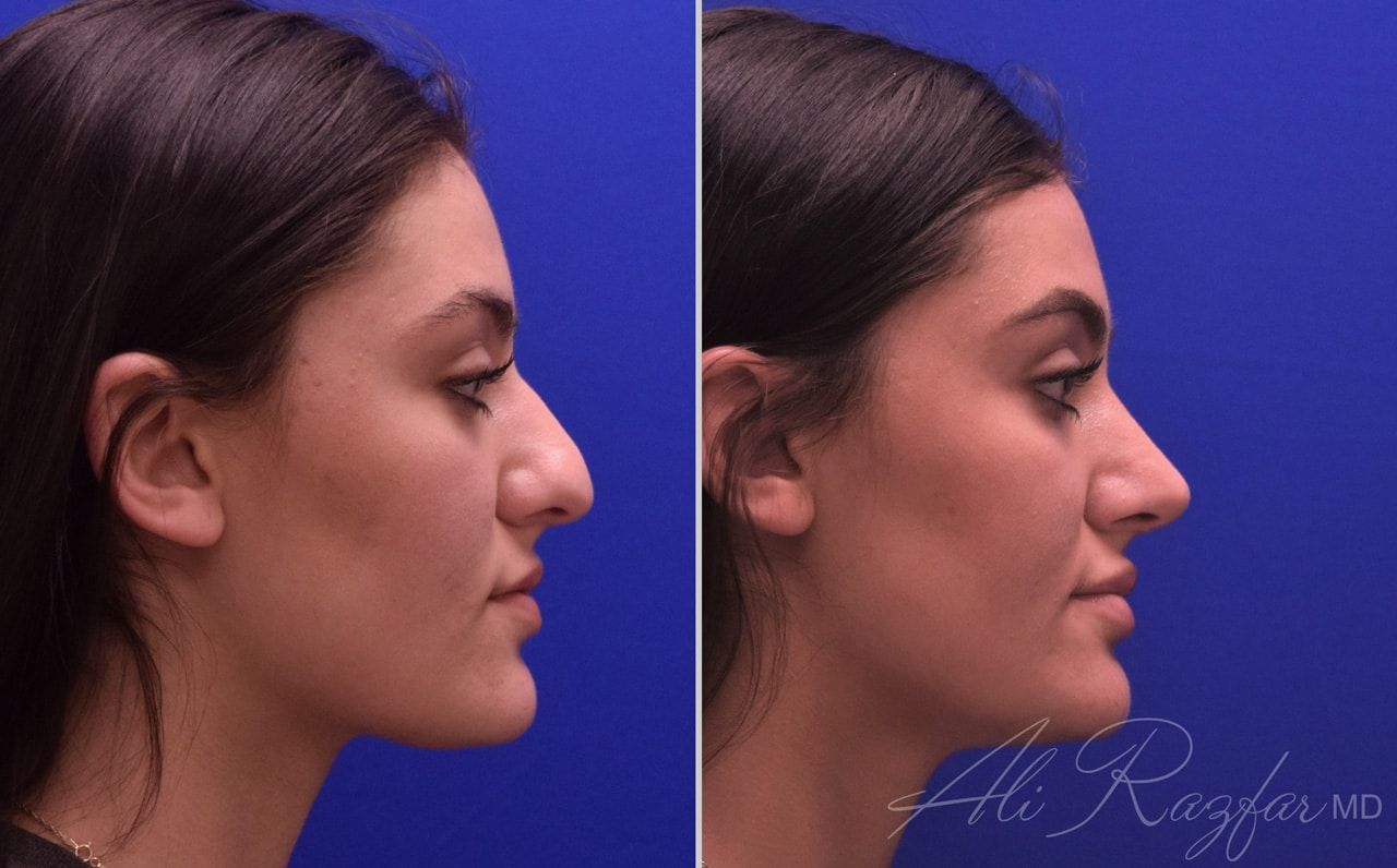 Rhinoplasty Before & After