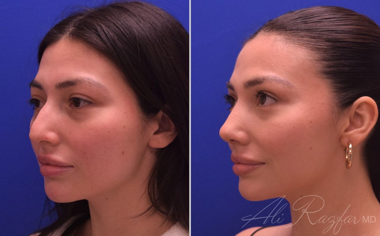 Rhinoplasty Before & After