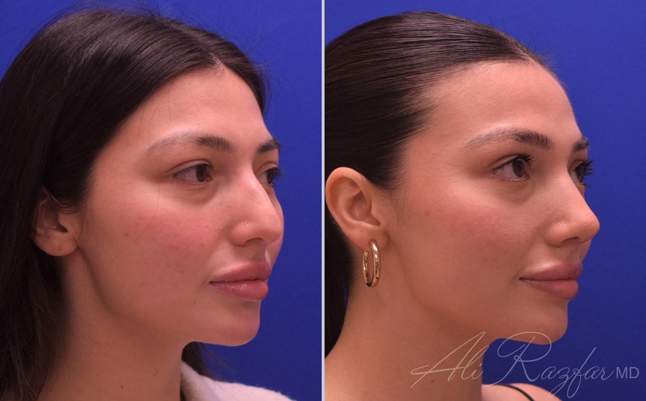Rhinoplasty Before & After