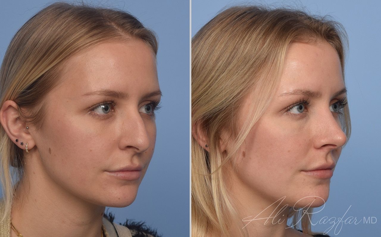 Rhinoplasty Before & After