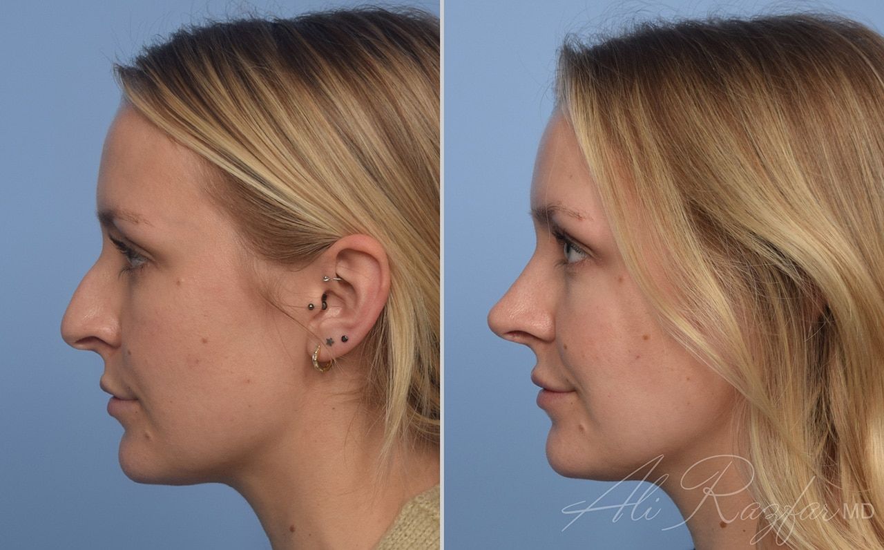 Rhinoplasty Before & After