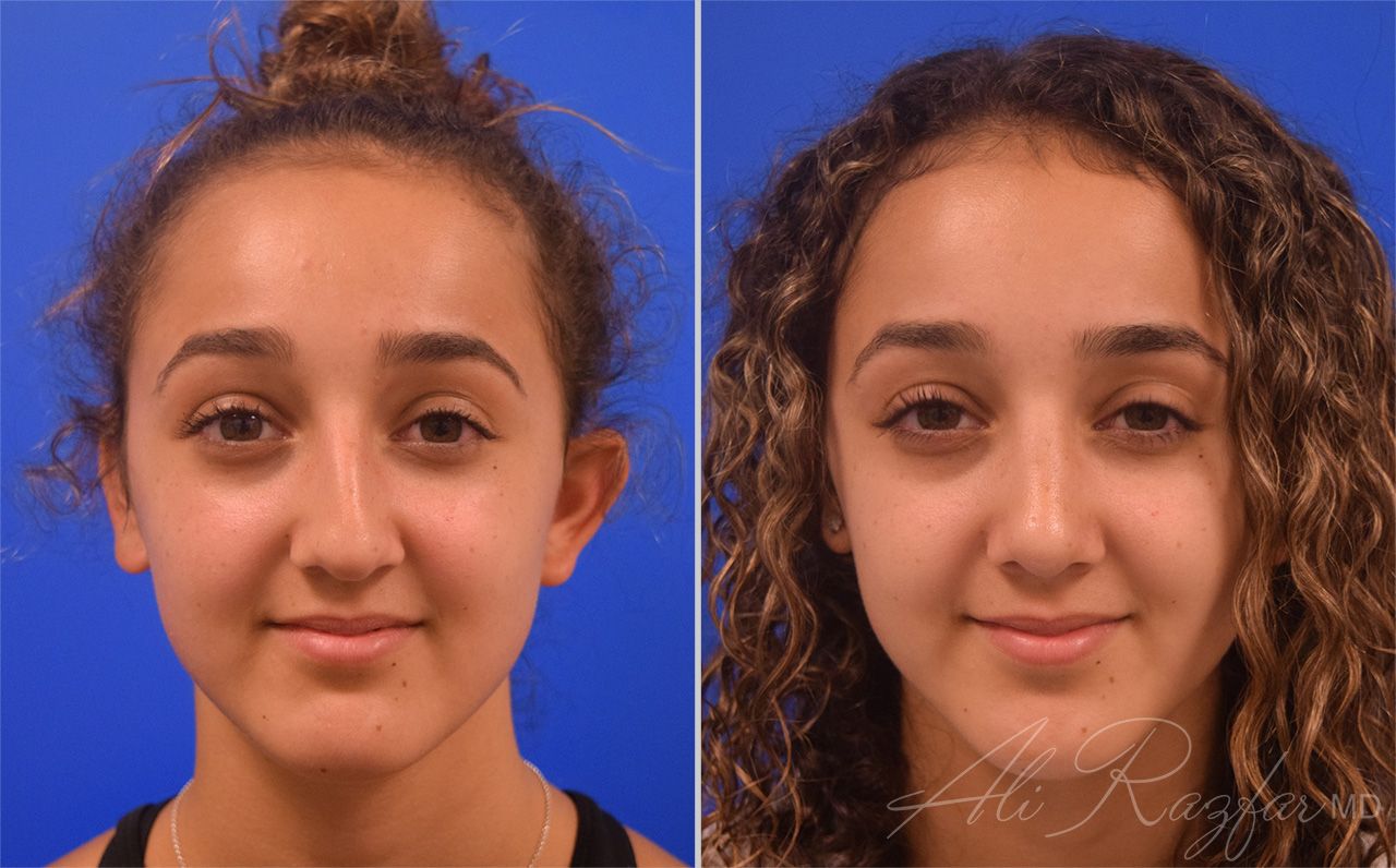 Rhinoplasty Before & After