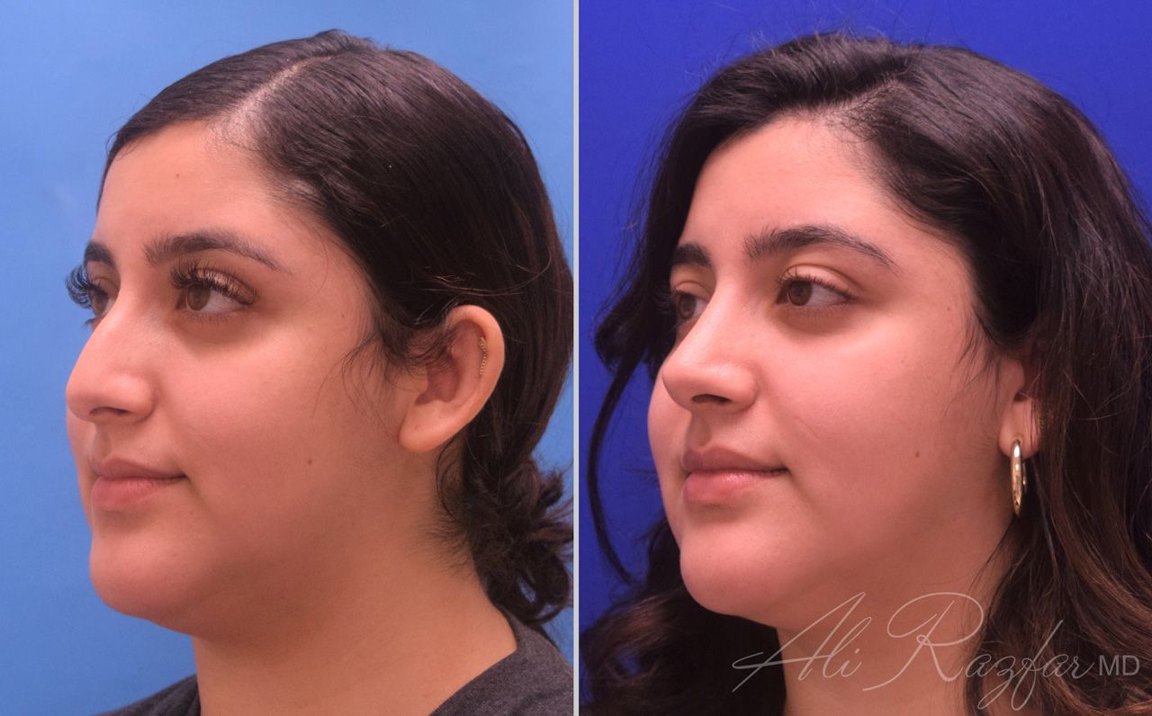 Rhinoplasty Before & After