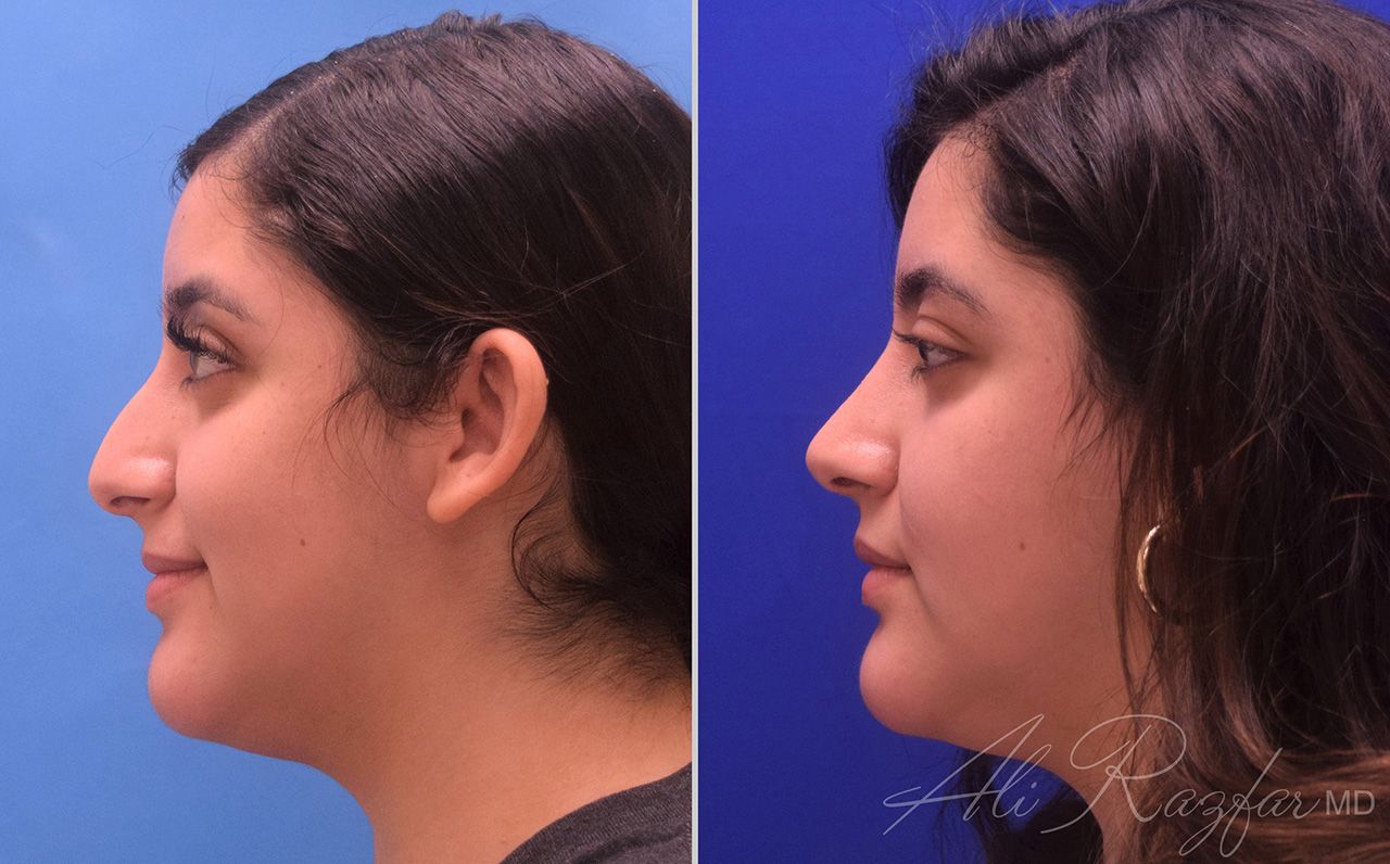 Rhinoplasty Before & After