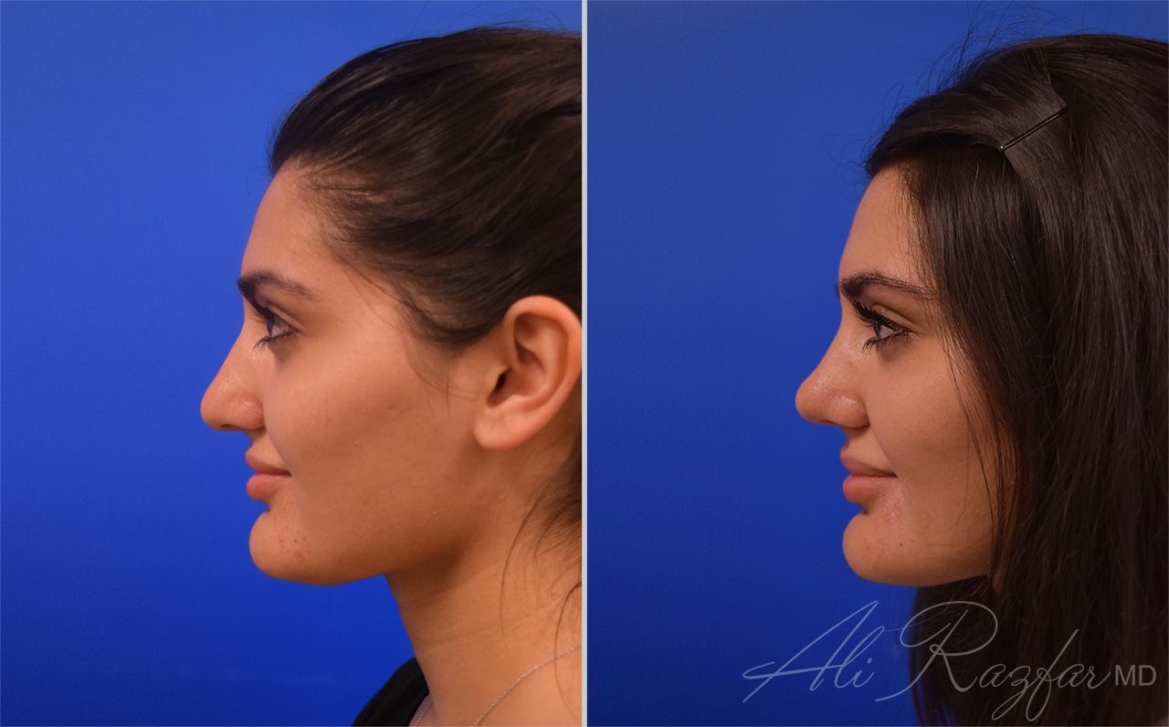 Rhinoplasty Before & After