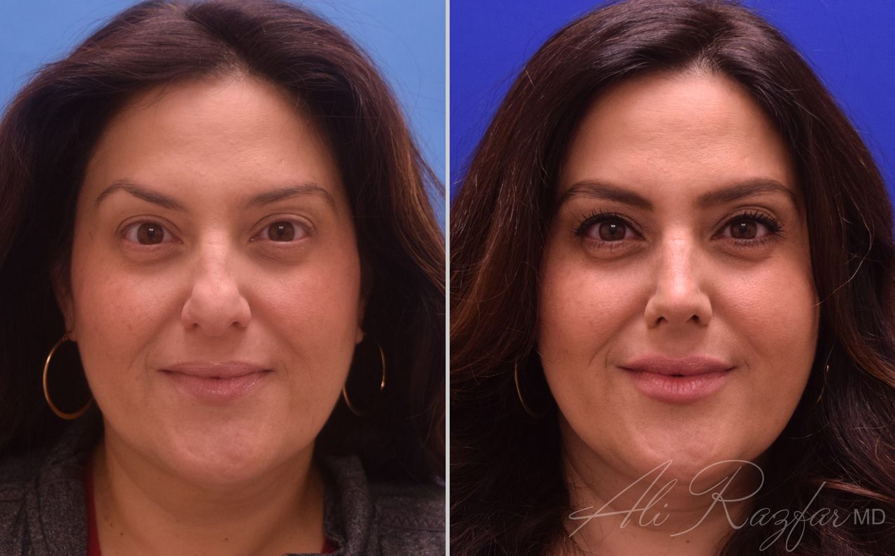 Rhinoplasty Before & After