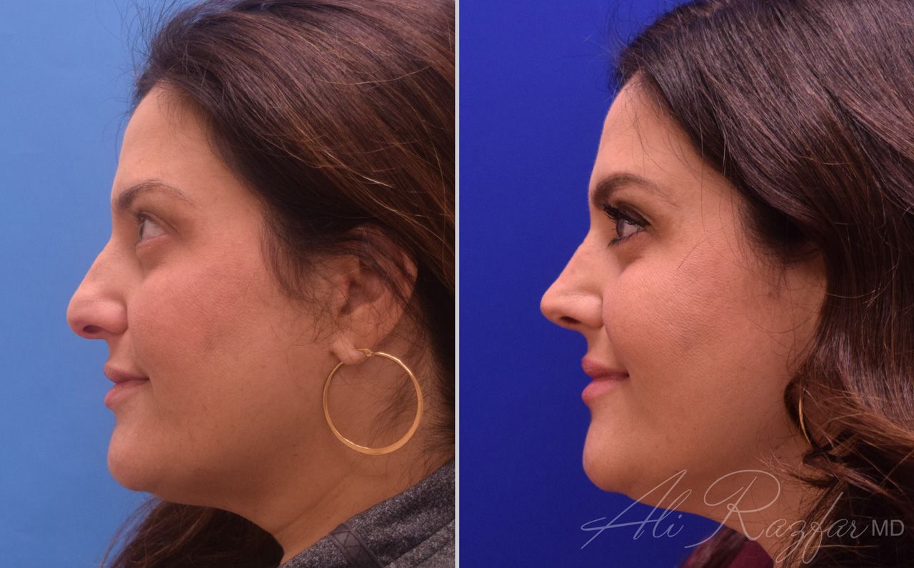 Rhinoplasty Before & After