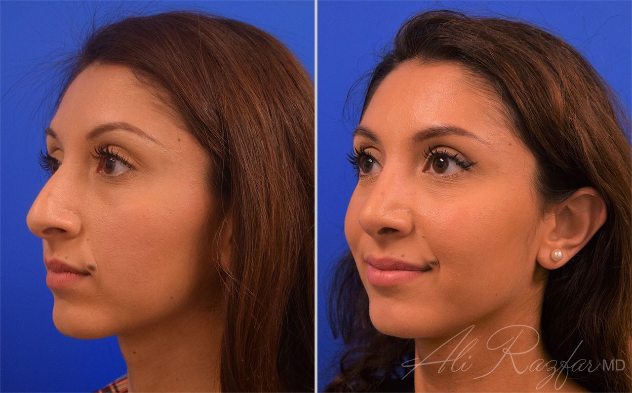 Rhinoplasty Before & After