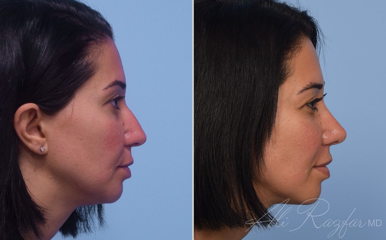 Rhinoplasty Before & After