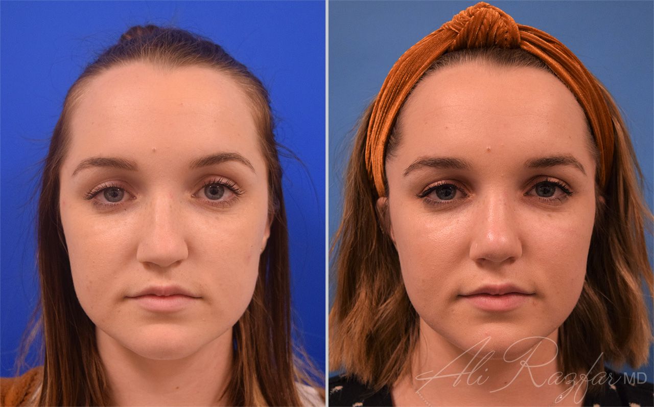 Rhinoplasty Before & After