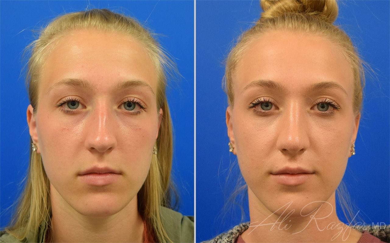Rhinoplasty Before & After
