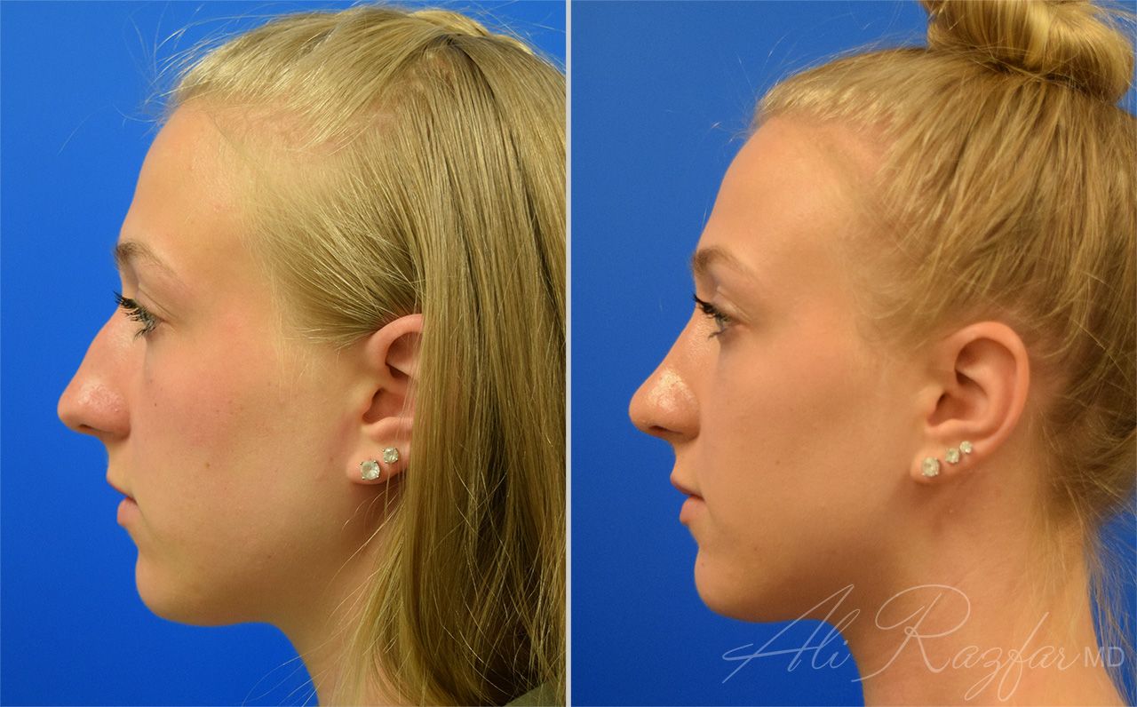 Rhinoplasty Before & After
