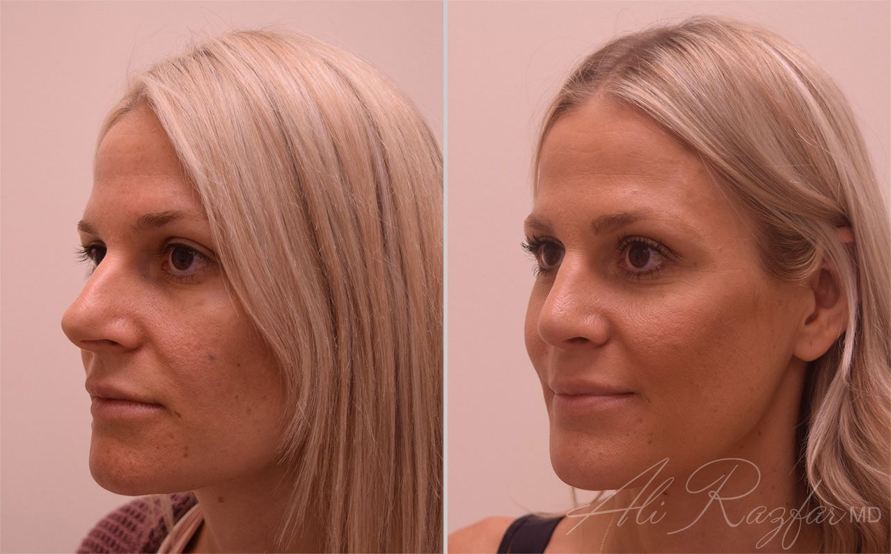 Rhinoplasty Before & After