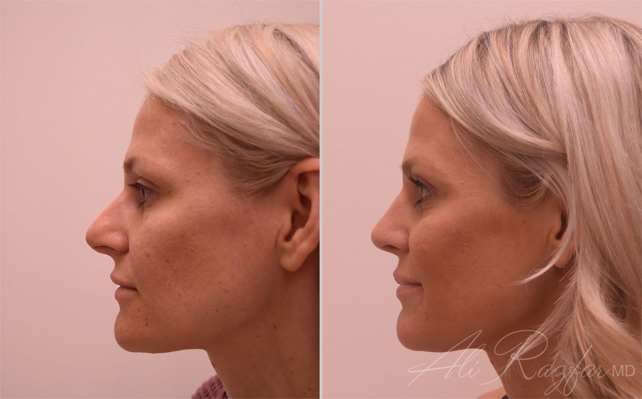 Rhinoplasty Before & After