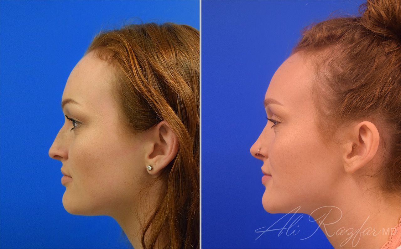 Rhinoplasty Before & After