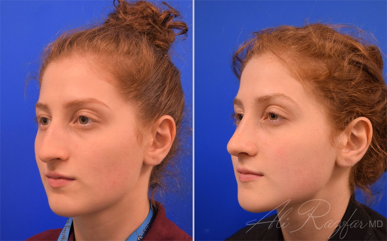 Rhinoplasty Before & After