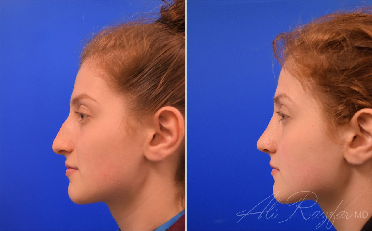 Rhinoplasty Before & After