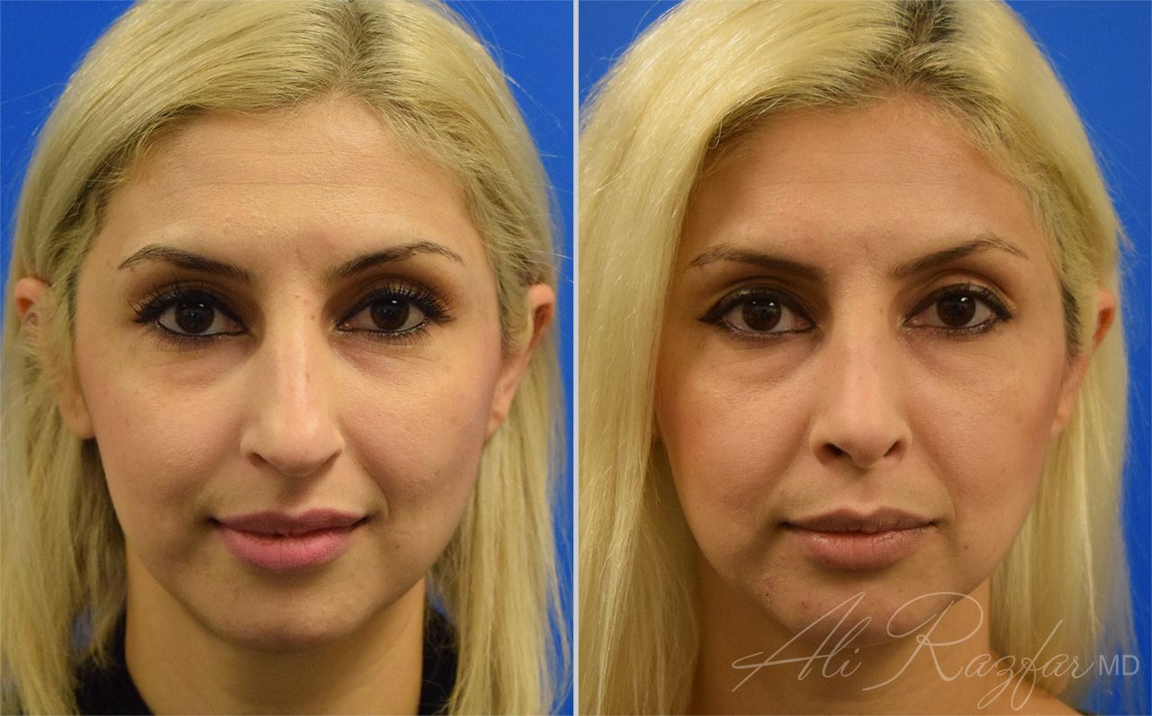 Rhinoplasty Before & After