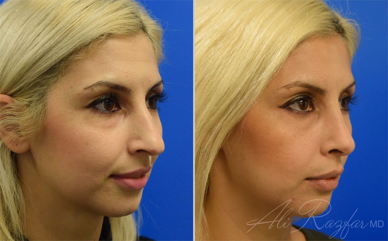Rhinoplasty Before & After